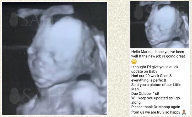 Success with healthy baby-boy from the first round ICSI