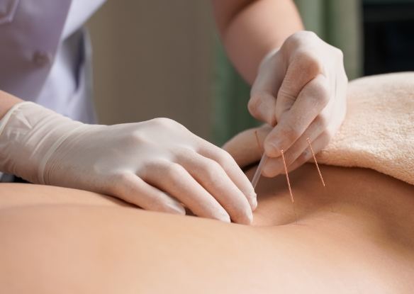 การฝังเข็ม