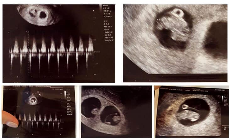 Twins boys, successful from ICSI-NGS