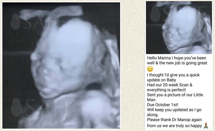 Success with healthy baby-boy from the first round ICSI